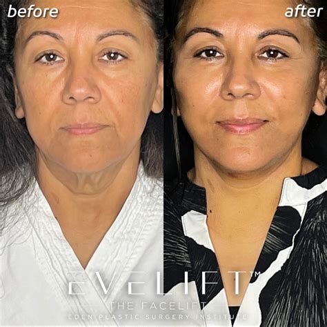 Evelift : An Alternative to Traditional Facelift