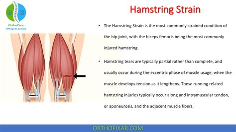 Everything You Need to Know About Hamstring Strains