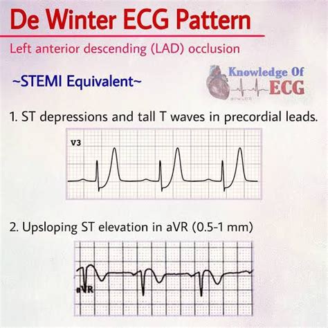 Evolutionary de Winter pattern: from STEMI to de Winter ECG—a …