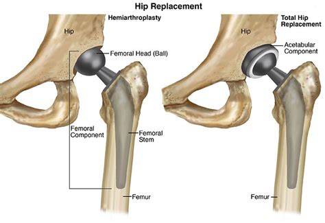 Evolving Clinical Experiences in Aesthetic Hip Implant Body …