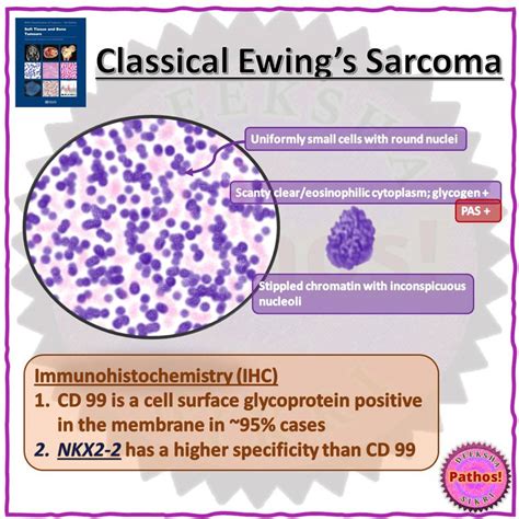 Ewing Sarcoma - Childhood and Adolescence - Diagnosis