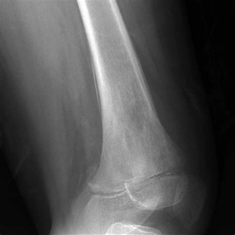 Ewing sarcoma Radiology Case Radiopaedia.org