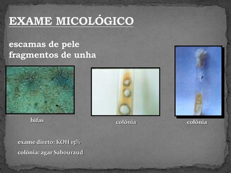 Exame Micol&oacute;gico Direto - micoclinicaufcspa