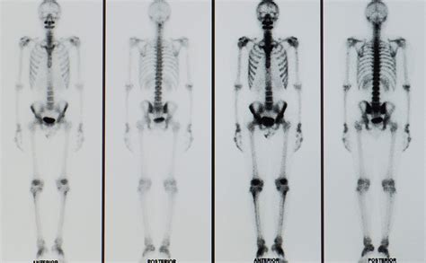 Examen óseo o gammagrafía de hueso - Radiologyinfo.org