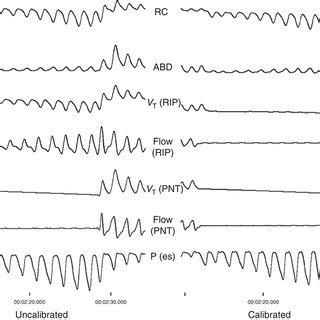 Example of negative inspiratory force (NIF) to achieve isovolume ...