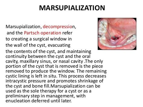 Excision or Marsipulization of Bartholins Gland Cysts