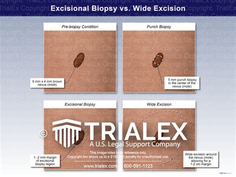 Excisional Biopsy of a Penile or Scrotal Lesion Excision of a