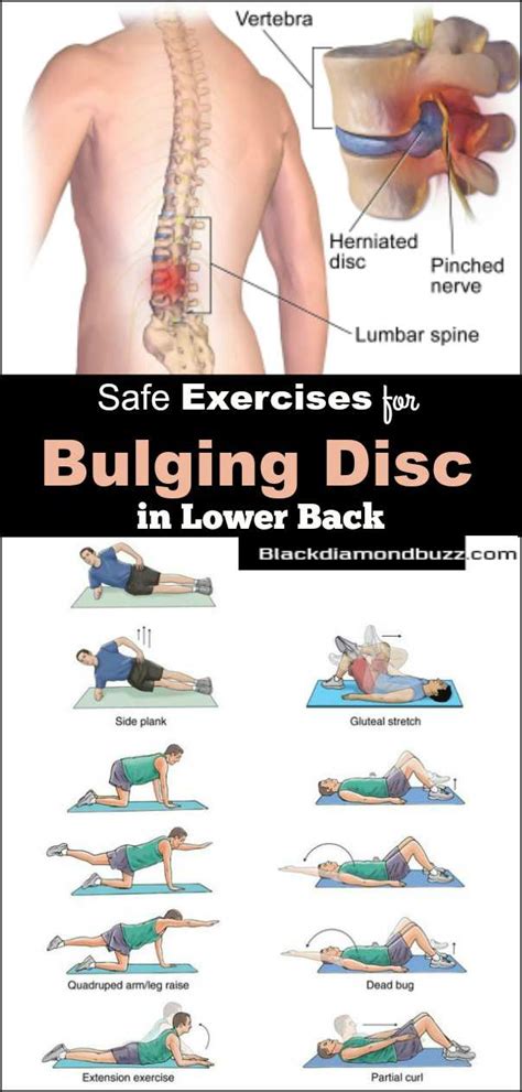 Exercises for compressed disc in lower back