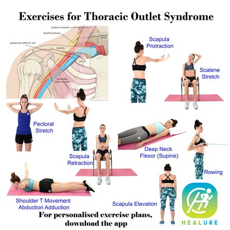 Exercises to Improve Thoracic Outlet Syndrome