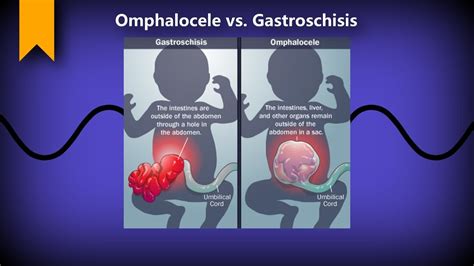 Exomphalos and Gastroschisis SpringerLink