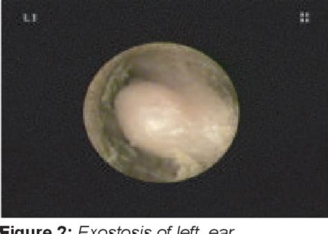 Exostoses of the external auditory canal - PubMed