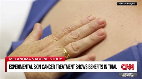 Experimental cancer vaccine, combined with immunotherapy, continues to show benefits against melanoma, trial shows