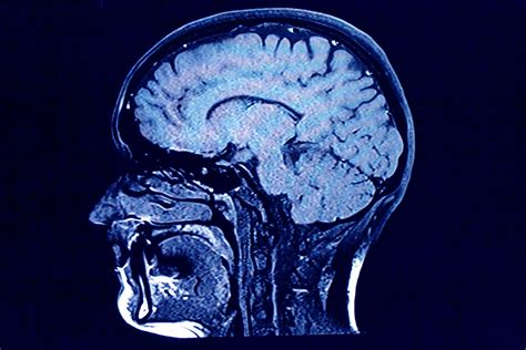 Experts Available to Discuss MS Epilepsy and Brain Injuries