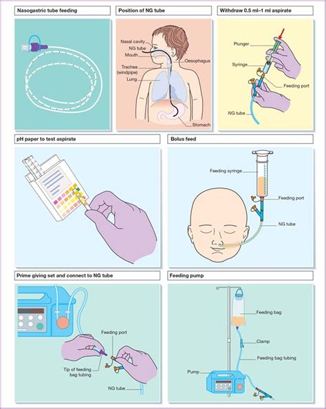 Explain the steps involved in providing an intermittent enteral feeding.. Explain the steps involved in providing an intermittent enteral feeding. First, the nurse should prepare the solution and remove the plunger from the 60 ml syringe. Then you should connect the syringe to the port and open the stopcock. 