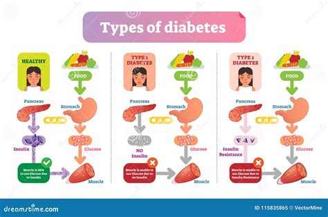 Explaining Diabetes MedHeadArts