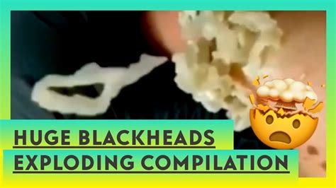 Exploding blackheads. Blackheads removal. The best Pimple Popping Videos. Blackheads removal satisfying video. Closed and open blackheads. Blackheads poppy tv.MUSIC:At Rest Kevin ... 