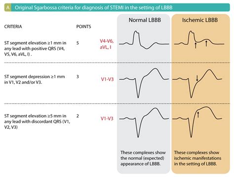 2024 Exploring the Left Bundle Branch Block ECG Criteria in Depth-marketplaceplus.shop