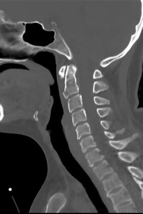 Extension teardrop fracture Radiology Reference Article - Radiopaedia