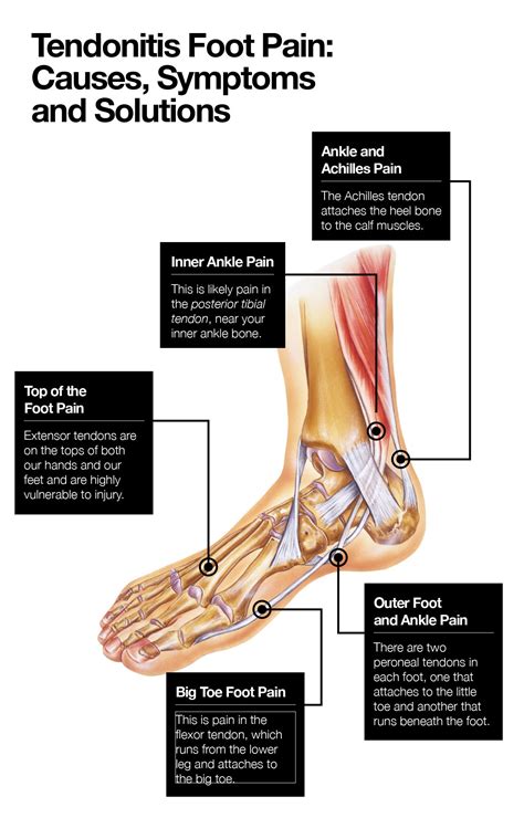 Extensor Tendonitis Causes Pain on Top of the Foot