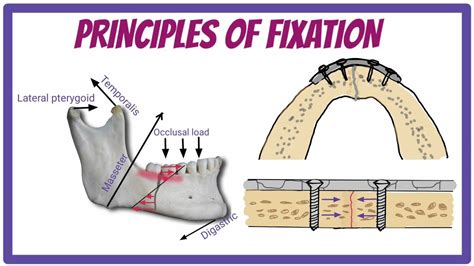 External fixation in maxillofacial surgery