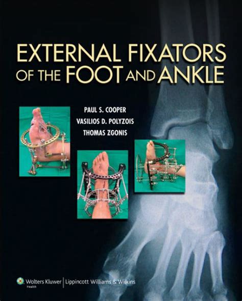 Download External Fixators Of The Foot And Ankle By Paul  Cooper