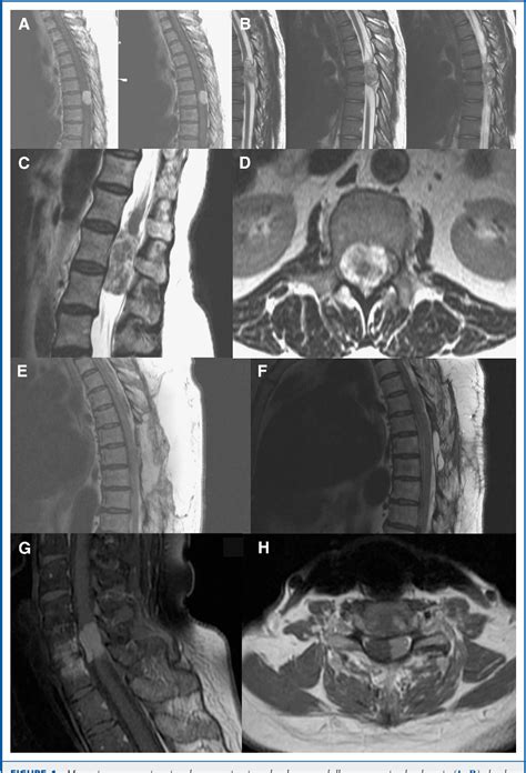 Extramedullary intradural spinal tumors: a review of modern ... - PubMed