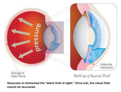 Eye Pressure Lowering Effect of Vitamin C - Herschell H. Boyd, …