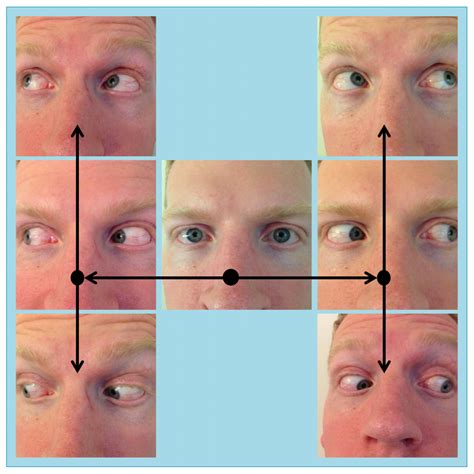 The present study used the Developmental Eye Movement test because it includes a vertical test to account for automaticity naming issues that may confound the assessment of isolated oculomotor deficits (Garzia et al., 1990). Interestingly, there was a correlation with our two most common abnormal measures, NPC and accommodative amplitude, with ...