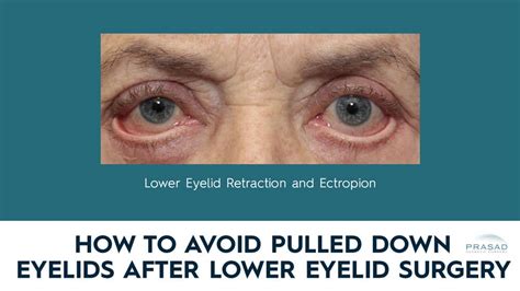 Eyelid Retraction - an overview ScienceDirect Topics