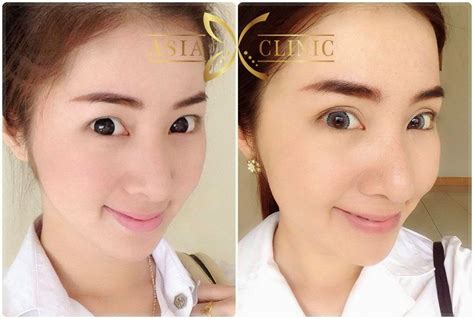 Eyelid Surgery in Phuket Province, Thailand • Check Prices