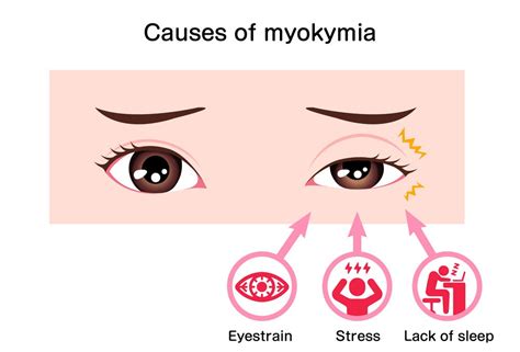 Eyelid twitching icd 10. Eyelid myokymia is a general term connoting complex, involuntary, repetitive electrical discharges surrounding any motor unit (muscle) within the body.1 With respect to the eye, it is known to … 