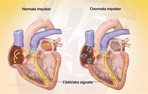 Förmaksflimmer ofarligt