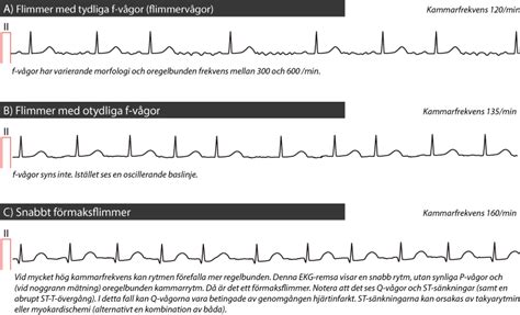 Förmaksflimmer pacemaker