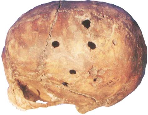Facts and Myths of Primitive 3 Trepanations - Springer - wintechmobiles.com