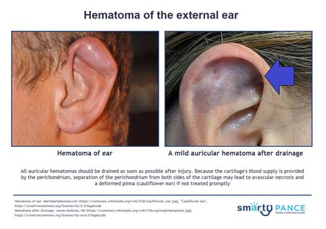 FAQ: Can an aural hematoma burst? - De Kooktips - Homepage