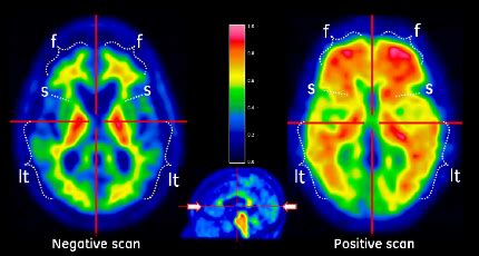 FDA Approves a Second Amyloid Imaging Agent ALZFORUM