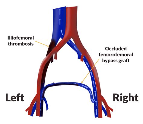 FEMORO-FEMORAL/FEMORAL BYPASS GRAFT - Norfolk and …