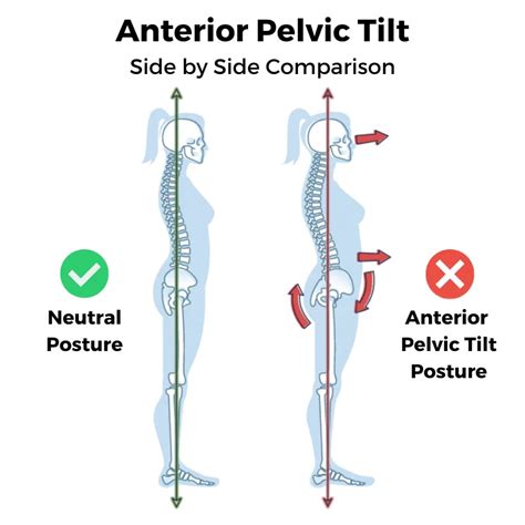 Fix Anterior Pelvic Tilt: A Practical Guide to Correct Posture, Relieve ... - balustradellc