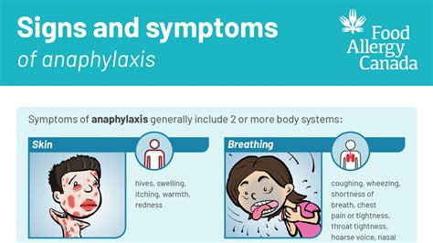 Food Allergy | Anaphylaxis | Food Allergies | MedlinePlus - balustradellc
