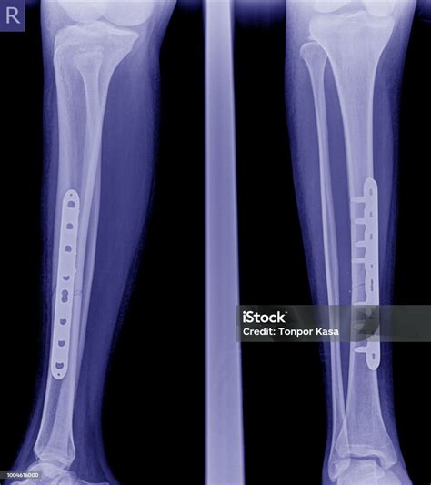 Foto Rontgen Kaki Patah - balustradellc