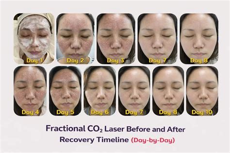 Fractional Laser - Prosedur, Tujuan, dan Efek Samping … - muktibox.com