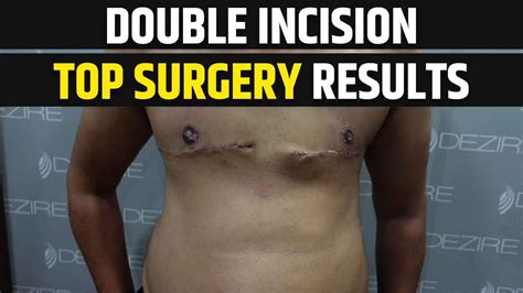 FTM and FTNB Double Incision Top Surgery: Early Postoperative ...