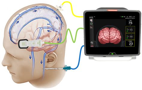 Functional Near-Infrared Spectroscopy Monitoring in Brain Injury and ... - wintechmobiles.com