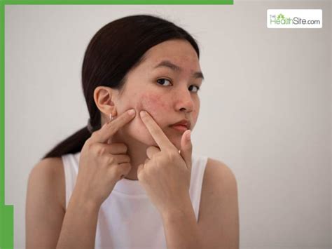 Fungal Acne: 5 Effective Ways to Treat Malassezia … - balustradellc