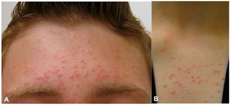 Fungal acne: Malassezia Folliculitis, Pityrosporum … - balustradellc