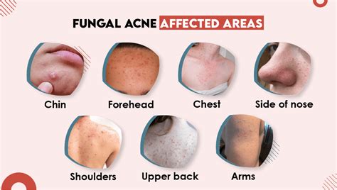 Fungal Acne: Symptoms, Causes, Treatment Options - balustradellc