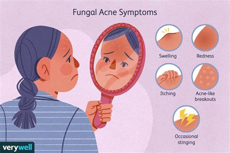 Fungal Acne: What Is It And How To Treat It - balustradellc