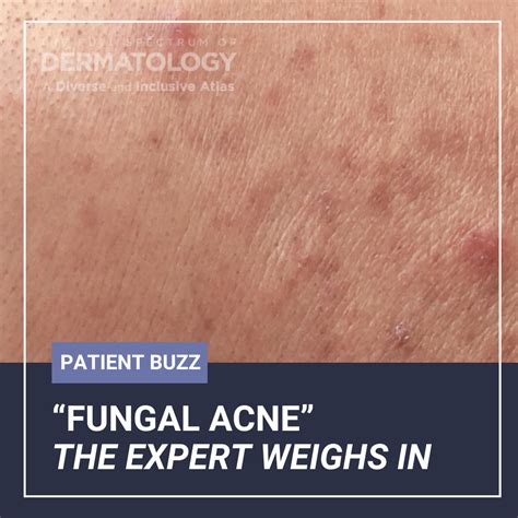 Fungal Acne - Dr Davin Lim | Dermatologist - balustradellc