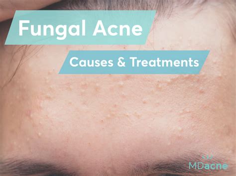 Fungal acne causes and treatments | MDacne - balustradellc