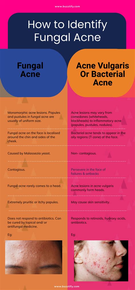 Fungal Acne Explained: A Deep Dive Into Causes - balustradellc